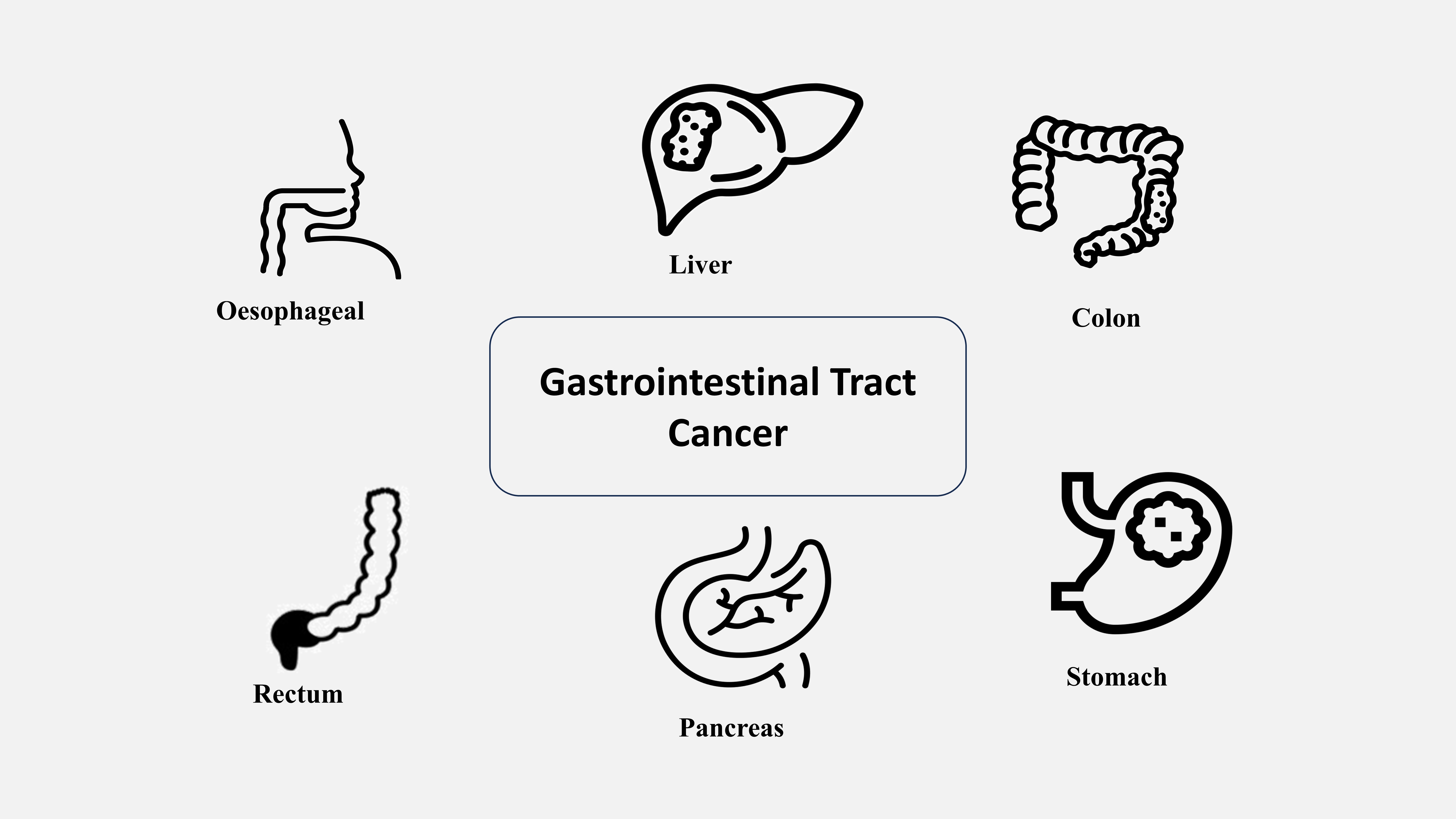 GI Tract Cancer
